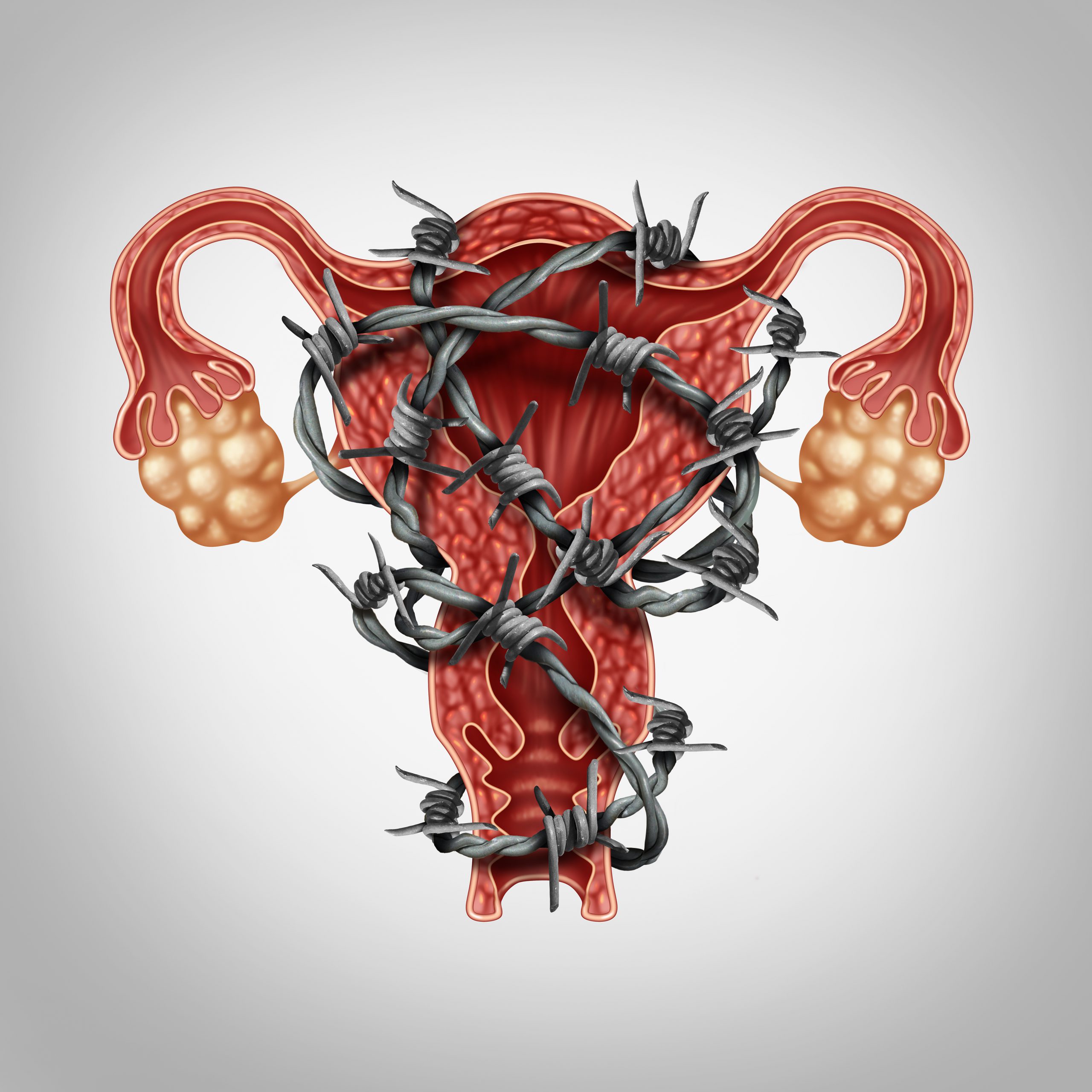 Uterus and abdominal pain medical concept with painful barbed wire wrapped on the anatomy as an endometriosis problem with the human female reproduction symbol as a symbol of fertility and reproductive system disease or illness.