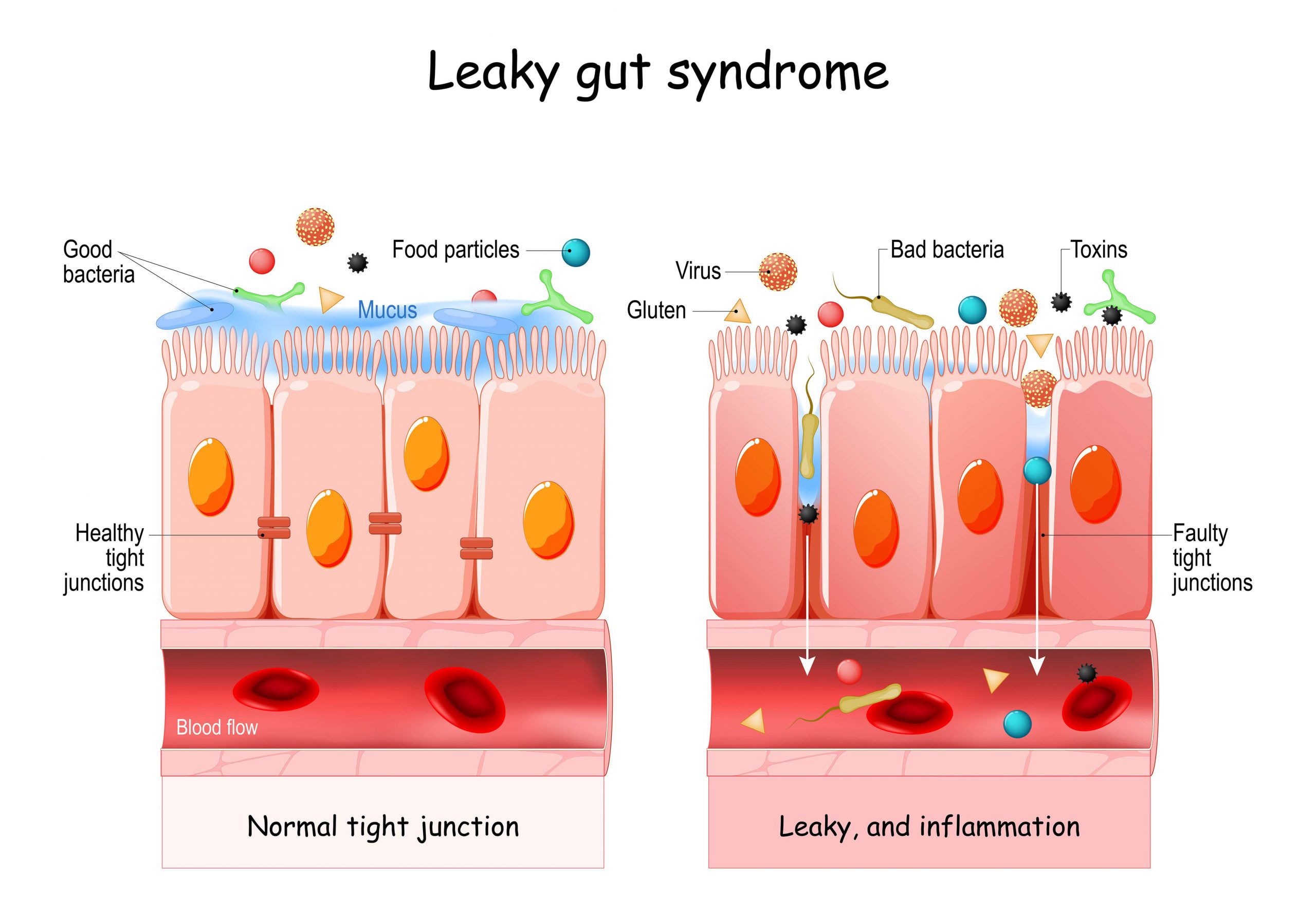 Natural Irritable bowel solutions treatment